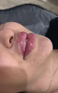 انجام خدمات ژل و بوتاکس با بهترین متریال