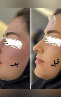 لیزرمو ژل لب فول فیس فیلر چانه گونه مزوبوتاکسprp