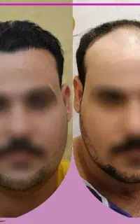 کاشت مو تخصصی شیرازی در اردبیل