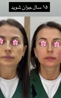 جراحی میدفیس