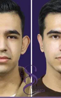 اتوپلاستی و اصلاح فرم گوش