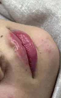 آف ویژه   در کلینیک   تزریق ژل، آنزیم،پی آر پی