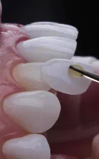 لمینیت دندان اقساطی محدود