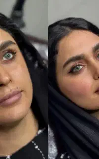 تزریق فیلر ب نواحی صورت همراه با اشانتیون