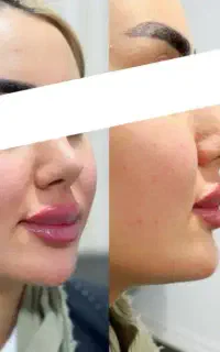 تزریق ژل بوتاکس فیلر مزو توسط پزشک