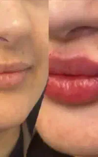 ژل لب و‌ فیلر