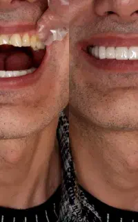 انجام لمینت متحرک دندان