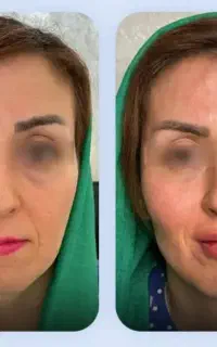 با خون خودت فیلر بساز زیبایی طبیعی