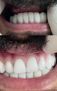 ساخت دندان مصنوعی به روش bps