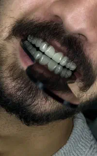 اوردنچر کره ای هرفک صد تومن/اقساطی بدون بهره