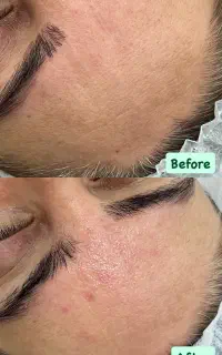 تخفیف فیشال صورت و دور چشم