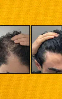 رویش جدید موهات
