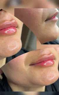 زیبایی نیلگون تخفیف میکروبلیدینگ،فیبروز،فیلر(ژل)
