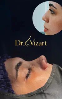 جشنواره تابستانه عمل زیبایی بینی