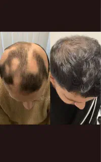 قطره گیاهی برای ریزش سکه ای ،ریش ومو