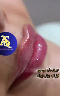 فیلر،بوتاکس،مزوتراپیprpتوسط پزشک در کلینیک معتبر