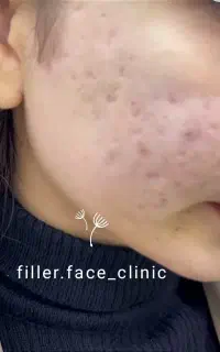 تخفیفات بوتاکس،پی ار پی،فیلر،فیشیال،مزو در مطب