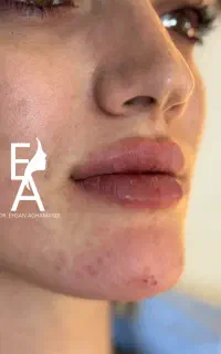 تزریق تخصصی توسط دکتر (فیلر بوتاکس جوانسازprpمزومو
