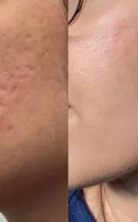 تخفیف مزونیدلینگ صورت