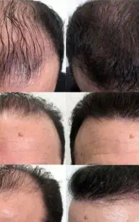 رفع ریزش مو با درمان گیاهی