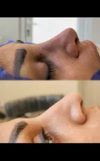 آف عمل زیبایی جراحی بینی ۲۵ت