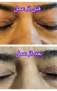 زیبائی پلک بالا و پائین