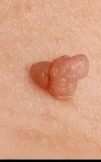 زگیل زیگیل خال ذگیل تناسلی hpv میخچه بواسیر hsv
