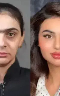 ژل بوتاکس لاغری تزریق چربی لیزر هایفو