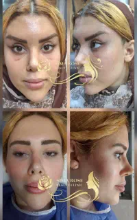اندولیفت جراحی لیفت شقیقه گونه ابروچشم مینی بلفارو
