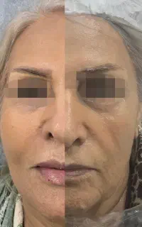 فول فیس چربی