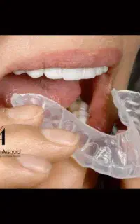 ساخت نایت گارد دندان(محافظ دندان قروچه)