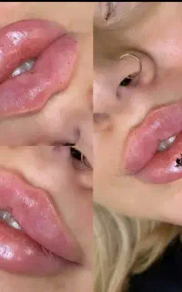 تزریق ژل فیلر بوتاکس فول فیس .مزوصورت لک چوش
