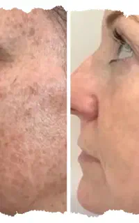 ریمو لک تنها در یک جلسه ( دائمی و بدون بازگشت )