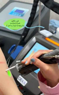 لیزر موهای زائد