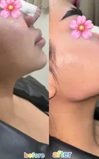 تزریق فیلر،ژل لب، آنزیم،بوتاکس