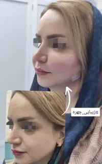 پزشک متخصص زیبایی صورت و اندام( پال) پلک چربی فیلر