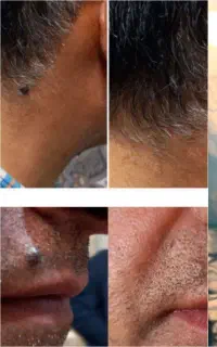 قطره خ ا ل بردار (گوشتی،زگیل،میخچه)ارسال کل ایران