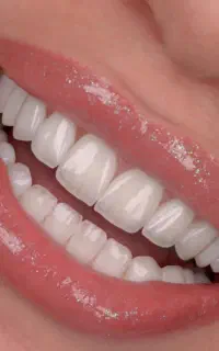 ایمپلنت اقساطی ،کامپوزیت ،لمینت