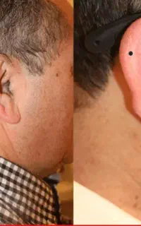 لیزر تخصصی ویژه آقایون