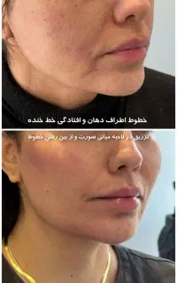 کلینیک تخصصی ژل، فیلر، بوتاکس ،لیزر با نتیجه طبیعی