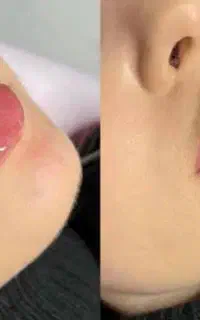 انجام فیلر یا ژل برای زیباجویان گرامی