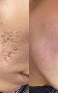 مزو‌پلاسما‌ و لیزر پیکوسکند لک.منافذ.اسکار