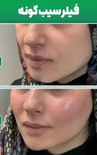 فیلر * بوتاکس * ژل