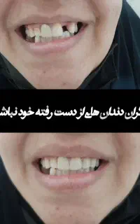 دندانسازی  ایمپلنت کامپوزیت  لمینت پروتز مصنوعی