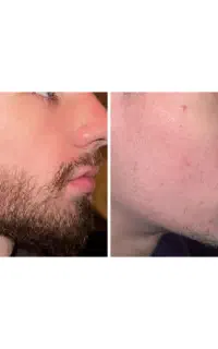 سرم تقویتی ریش سیبیل
