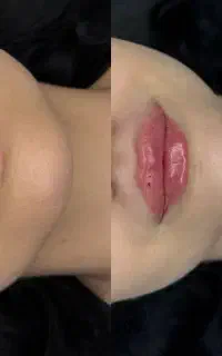 تزریق فیلر لب روسی