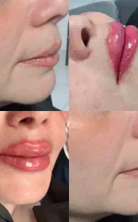 بلفاروپلاستی لیفت شقیقه ژل بوتاکس لیپوساکشن