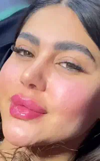 فیلر لب و بوتاکس و مزو صورت