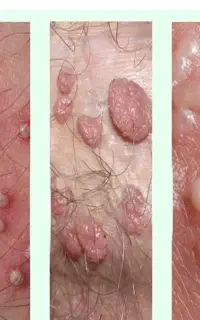 رفع قطعی و دائمی زگیل و تبخال