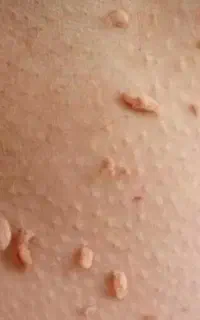 جشنواره تخفیفی رفع خال ،نشانه ومنگوله گوشتی،کک ومک
